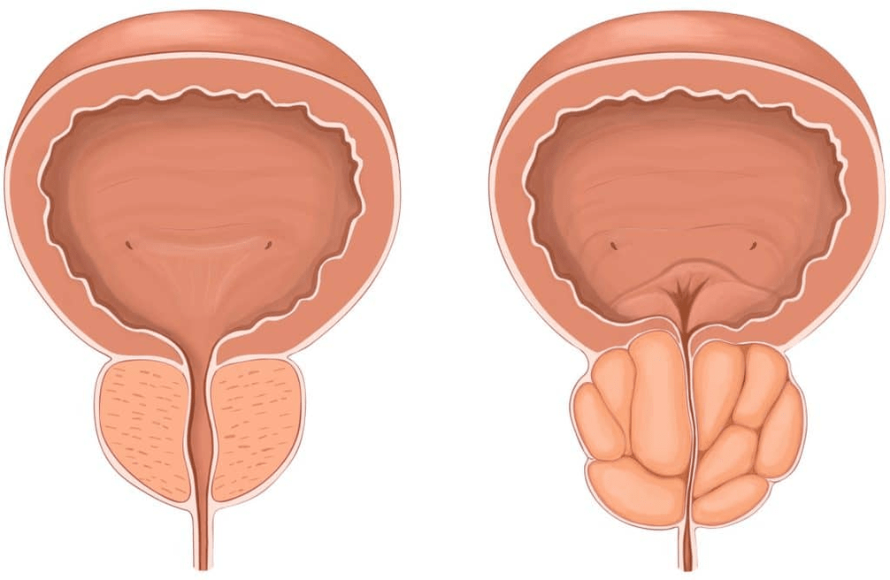 Qu'arrive-t-il à la prostate pendant la prostatite