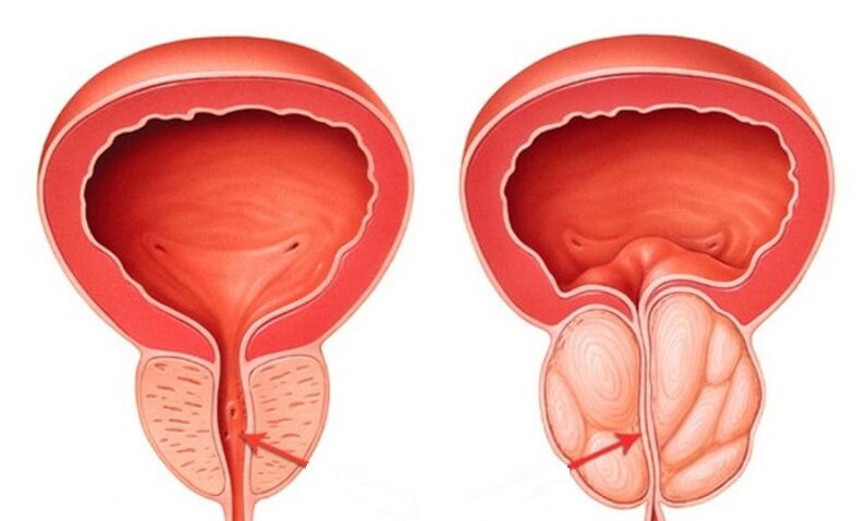 Prostate saine et enflammée avec prostatite