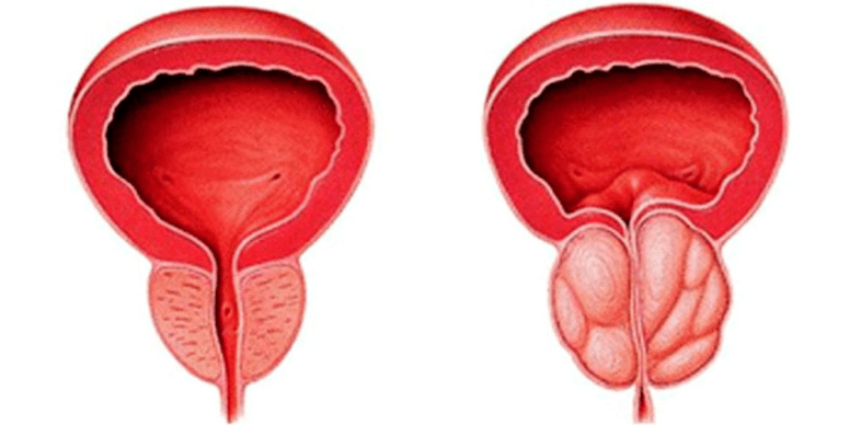 Prostate normale et enflammée